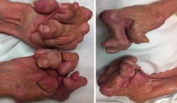 Cận cảnh đôi bàn tay bị biến dạng kinh hoàng do không điều trị viêm khớp
