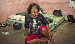 Người phụ nữ biến dạng vì khối u phải đi ăn xin kiếm sống