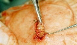 Hãi hùng chứng kiến bác sĩ gắp dòi làm tổ trên cơ thể người đàn ông