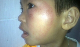 Mẹ hiệu trưởng đánh bầm dập trẻ mầm non 