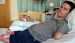 Nội tạng bị hủy hoại, cắt bỏ 3 chi vì vi khuẩn ăn thịt người tấn công