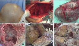 Phẫu thuật cắt bỏ khối u 40 kg trong buồng trứng bệnh nhân