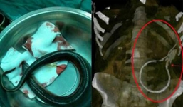 Ốc sên làm tổ trên đầu gối, lươn 0.5 kg bơi trong bụng người