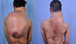 Chàng trai mang khối u 13 kg trên lưng
