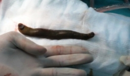 Đỉa 5 cm sống trong khí quản, cá bơi trong phổi bé trai