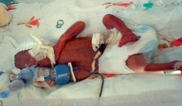 Bé sơ sinh nhỏ bằng bàn tay sống sót diệu kỳ