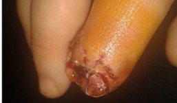 Bị cụt ngón tay sau khi dùng keo dán móng tay giả