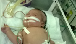 Bé sơ sinh bị hoại tử tay do tiêm Vacin: Có thể phải tháo khớp ngón tay
