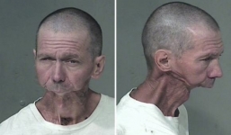 Bị khuyết hàm dưới vì dùng ma túy quá đà