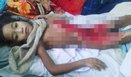 Bé gái bị bỏng nặng ở vùng kín và ổ bụng vì nướng ngô được cấy da