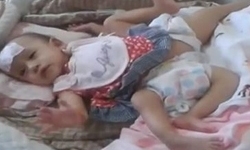 Xót xa bé gái sơ sinh có 4 chân và 2 bộ phận sinh dục