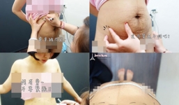 Cận cảnh một ca hút mỡ bụng sau sinh 