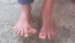 Kỳ lạ: Ông lão có 26 ngón tay, chân