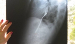 Bị bác sĩ từ chối gắp bỏ chiếc dĩa mắc trong cổ họng vì… “đó là lỗi của anh ta”