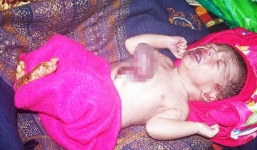 Bé sơ sinh có trái tim trồi ra ngoài lồng ngực