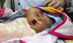 Xót thương bé sơ sinh có đầu hình trái tim vì bị u ác tính