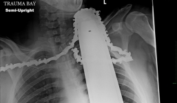 Thoát chết hy hữu khi bị lưỡi cưa găm chặt vào cổ