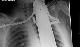 Thoát chết kì diệu sau khi bị cưa máy đâm vào cổ