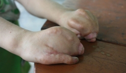 Bé gái mang khuôn mặt bà lão, các ngón tay chân dính liền