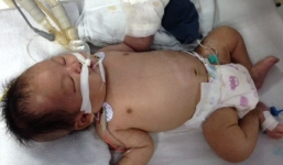 Bé sơ sinh bị hoại tử bàn tay sau tiêm phòng đã tử vong