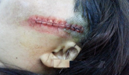 Bố chồng vô cớ đấm đá, chém trọng thương con dâu