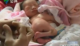 Bé trai sơ sinh chào đời có 4 chân, 4 tay