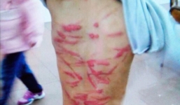 Không làm bài tập về nhà, cậu bé 6 tuổi bị mẹ đánh bầm dập