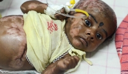 Kỳ lạ em bé bị bỏng nặng vì tự bốc cháy