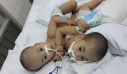 Cặp song sinh Long- Phụng hết 1,2 tỷ đồng tiền viện phí