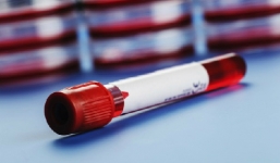 Xét nghiệm máu phát hiện sớm ung thư