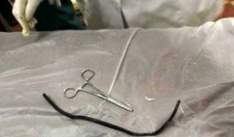 Sợi dây điện dài 40 cm nằm trong bụng người đàn ông gần 2 năm