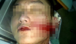 Kinh hoàng nam sinh Hải Phòng bị rạch mặt dã man