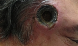 Người đàn ông bí ẩn bị thủng một 'lỗ đen' trên thái dương