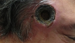 Bị thủng thái dương vì sử dụng thuốc cấm