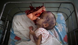 Nhói lòng trẻ Việt Nam nhiễm chất độc màu da cam trên báo nước ngoài