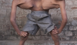 Cận cảnh cuộc sống của cặp song sinh dính liền thân