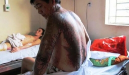 Bị tạt axit, người đàn ông ngã khụy giữa đường