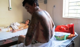 Đi tập thể dục, 4 người bị tạt axit