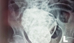 Cụ bà 76 tuổi mang thai: 'Sản phụ' không phải mổ, được xuất viện