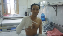 Bị cưa mất tay vì ngã vào bếp than khi lên cơn động kinh