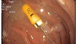 Bé trai bị kim chui vào dạ dày khi đi chữa răng