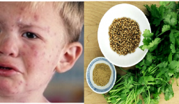 Bệnh sởi: Bài thuốc dân gian phòng và điều trị cho trẻ