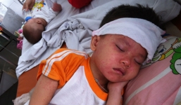 Bệnh sởi: Biểu hiện bệnh sởi, phòng tránh điều trị sởi