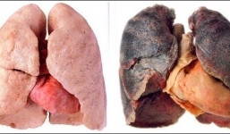 Xem thuốc lá phá hoại lá phổi như thế nào