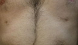 Người đàn ông có tới 6 núm vú trên cơ thể