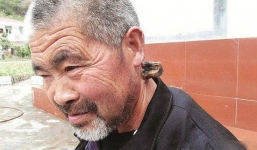 Chiếc sừng 'bí ẩn' mọc sau gáy phát triển không ngừng