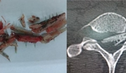 Xác định thủ phạm gây chấn thương cột sống cổ du khách Nga