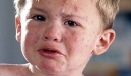 Chế độ dinh dưỡng và kiêng kỵ khi trẻ mắc sởi