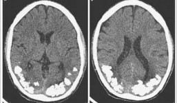 Phát hiện sỏi trong não bộ của người đàn ông suốt 10 năm