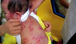 Dịch sởi bùng lên là tại dân, tại trời, không phải tại Bộ Y tế? 